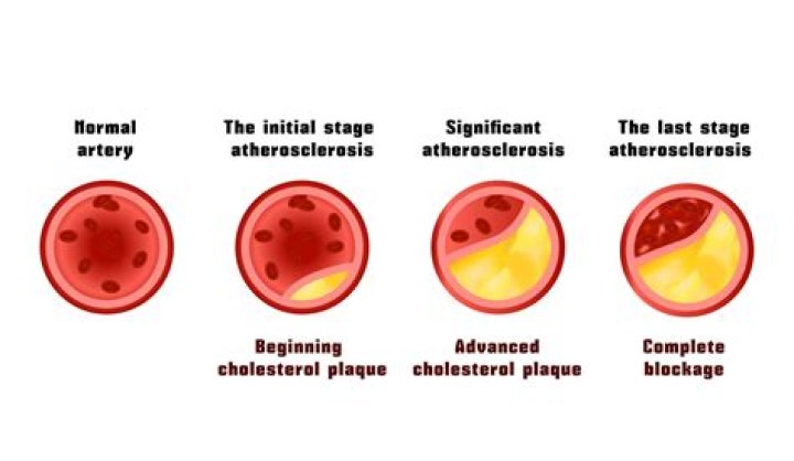 Does sodium clog arteries?