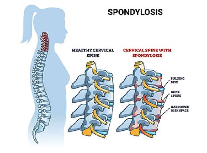 Does spondylosis cause dizziness?