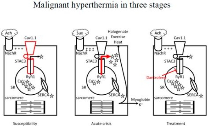 Does succinylcholine trigger malignant hyperthermia?