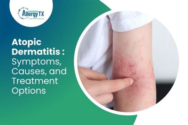 Does sugar cause atopic dermatitis?