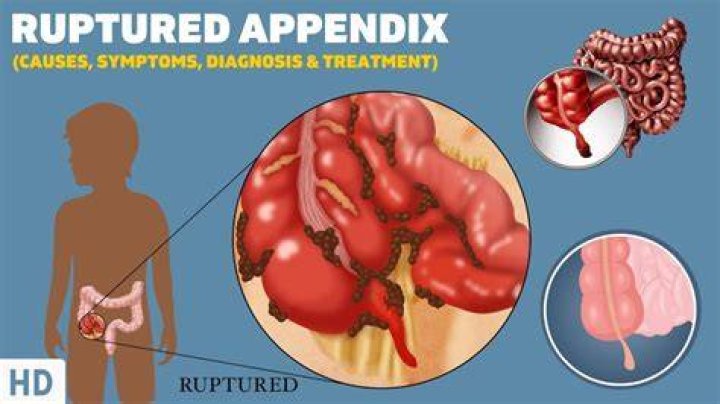 Has anyone survived a ruptured appendix?