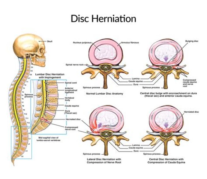 How does disc herniations happen?