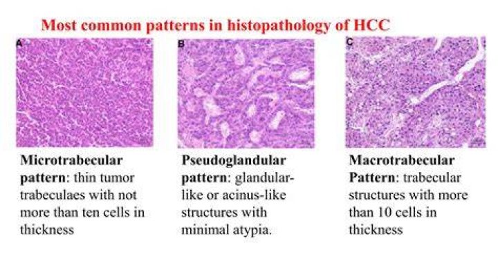 How does hepatocellular carcinoma spread?