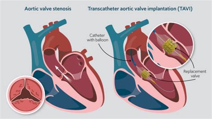 How is tavi performed?