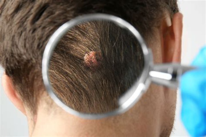 How to remove a mole off your head?