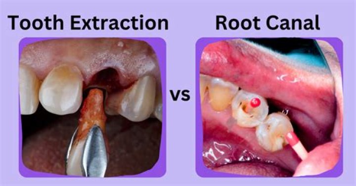 How to remove a teeth?