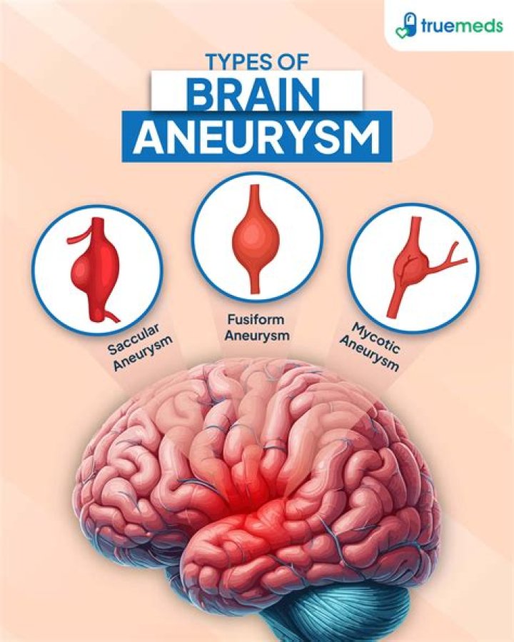 How to spell brain aneurysm?