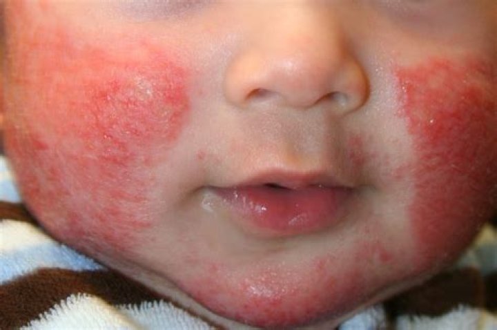 Is atopic dermatitis eczema?