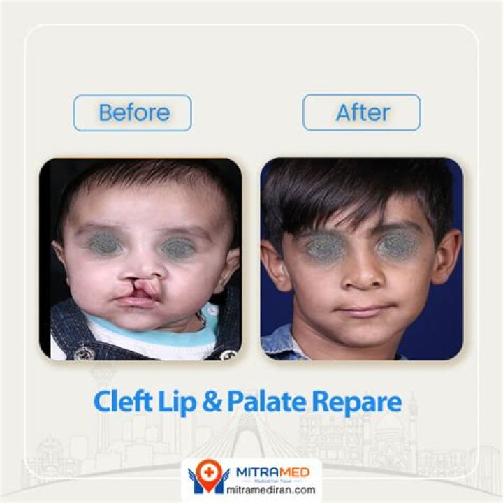 Is cleft palate surgery dangerous?