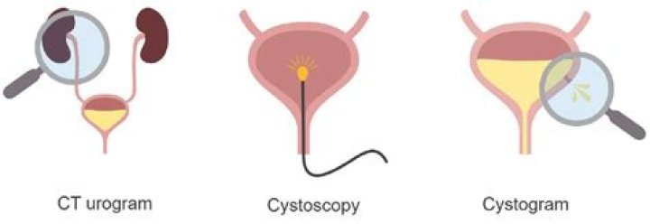 Is cystoscopy necessary after ct scan?