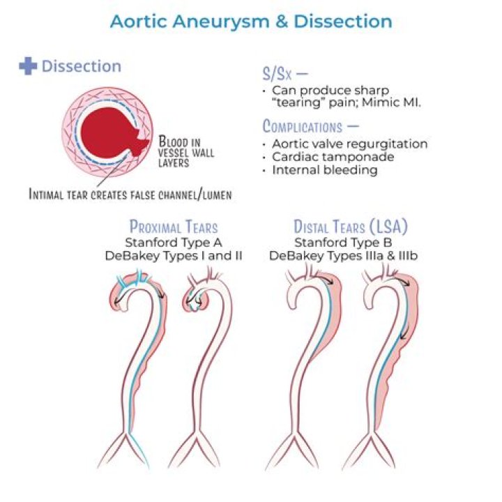 Is dissecting aortic aneurysm hereditary?