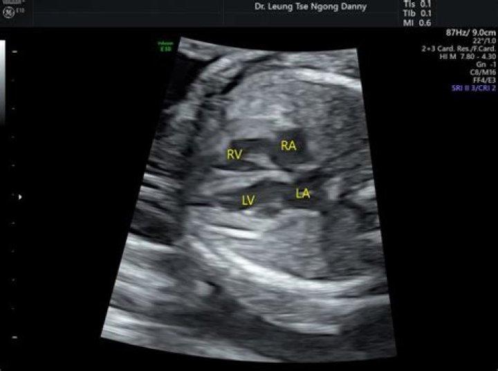 Is echogenic intracardiac focus normal?