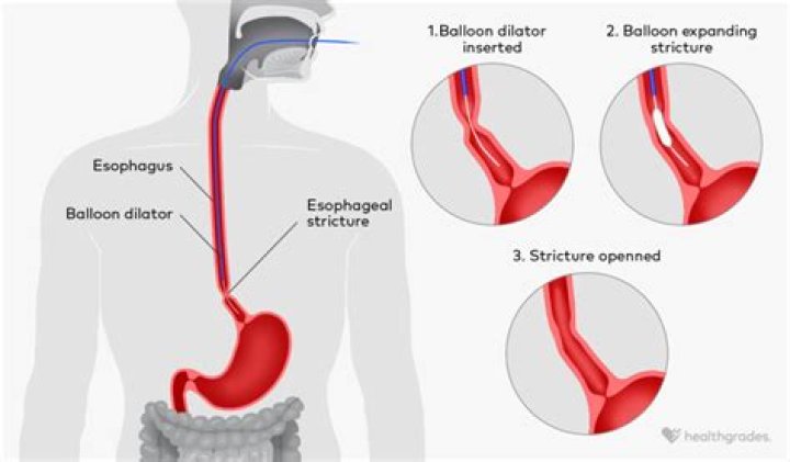 Is esophageal strictures curable?