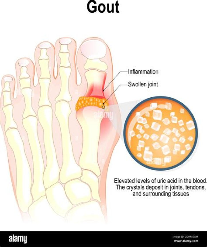 Is gout uric acid?