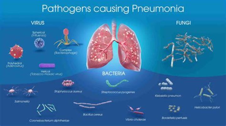 Is pneumonia a virus?