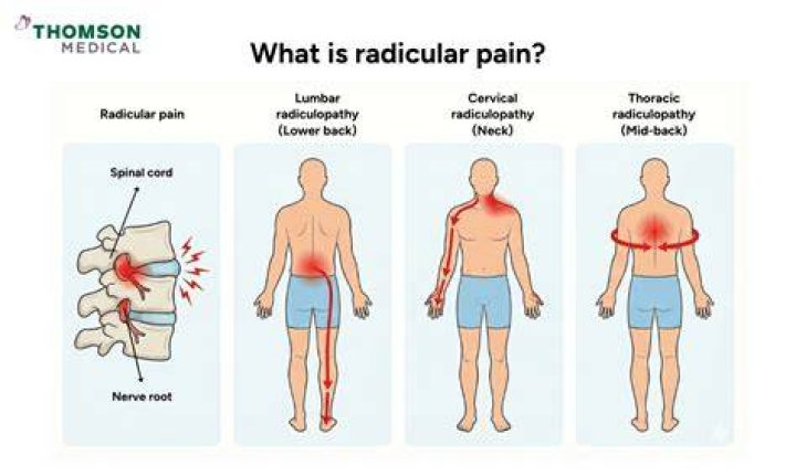 Is radicular a word?