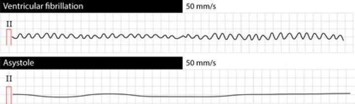 Is ventricular fibrillation pulseless?