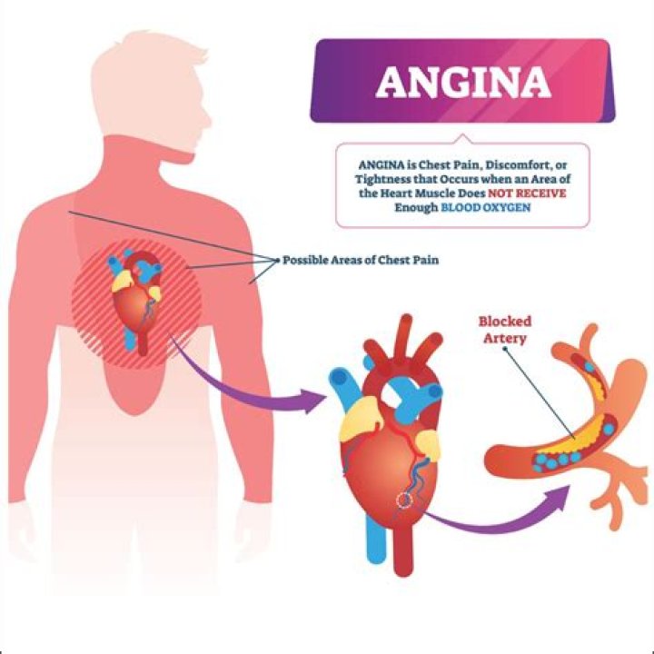 Should angina be treated?