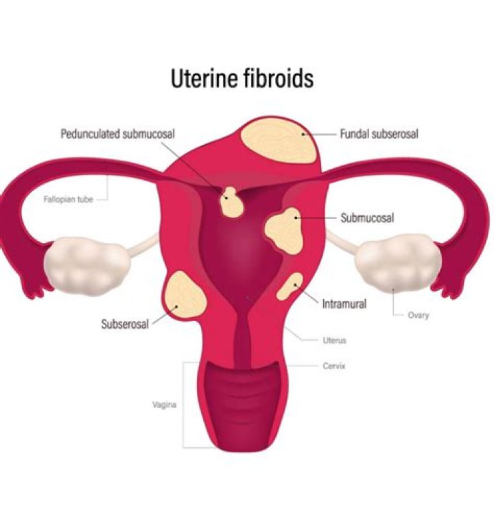 Should fibroids be treated?