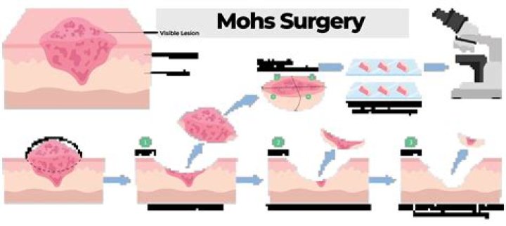 Should i have mohs surgery?