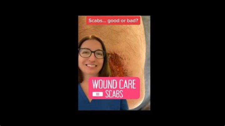 Should scabs be moisturized?