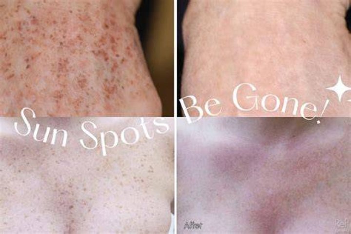 Should sunspots be removed?