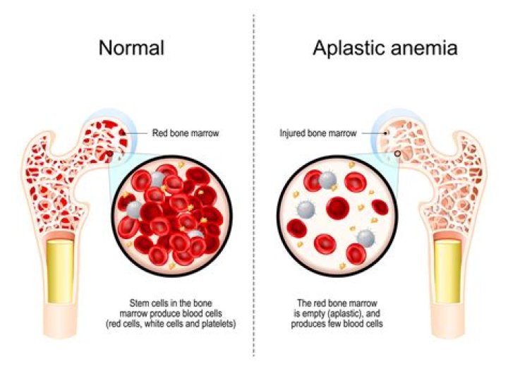 Was does aplastic mean?