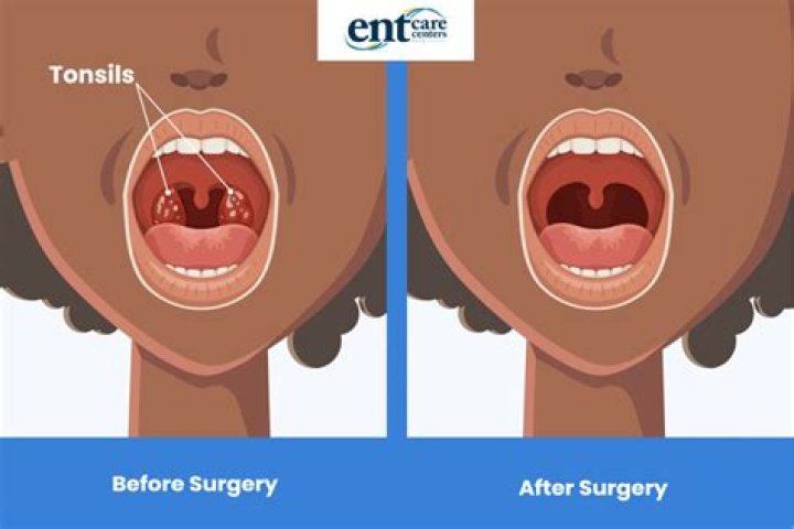 Was i born without tonsils?