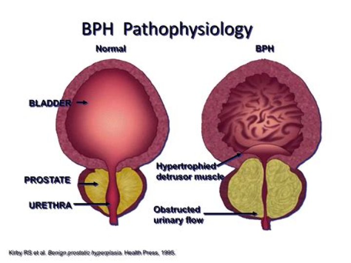 What bph stands for?