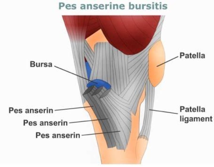 What causes anserine bursitis?