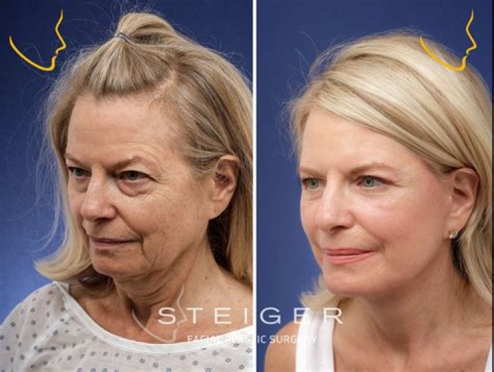 What do facelifts cost?