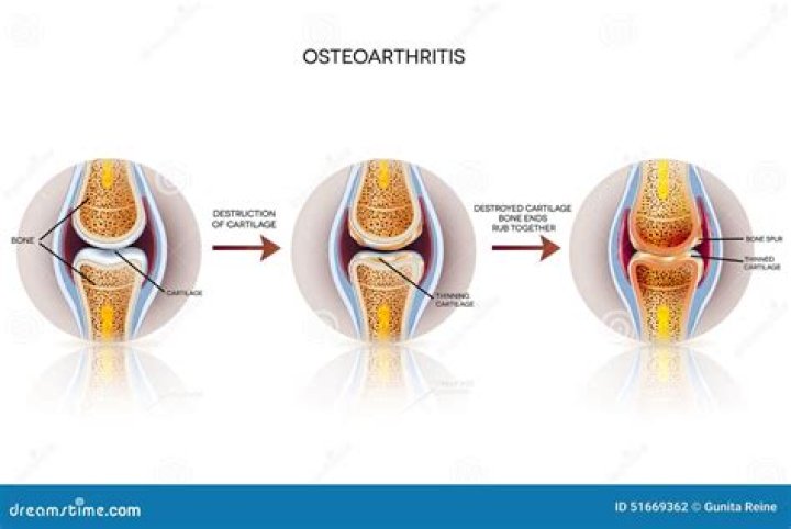 What does osteoarthritic changes mean?