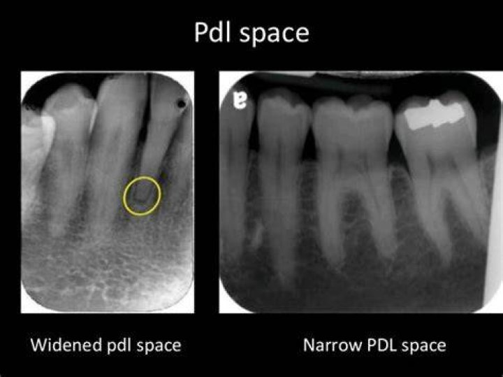 What does parl mean in dentistry?