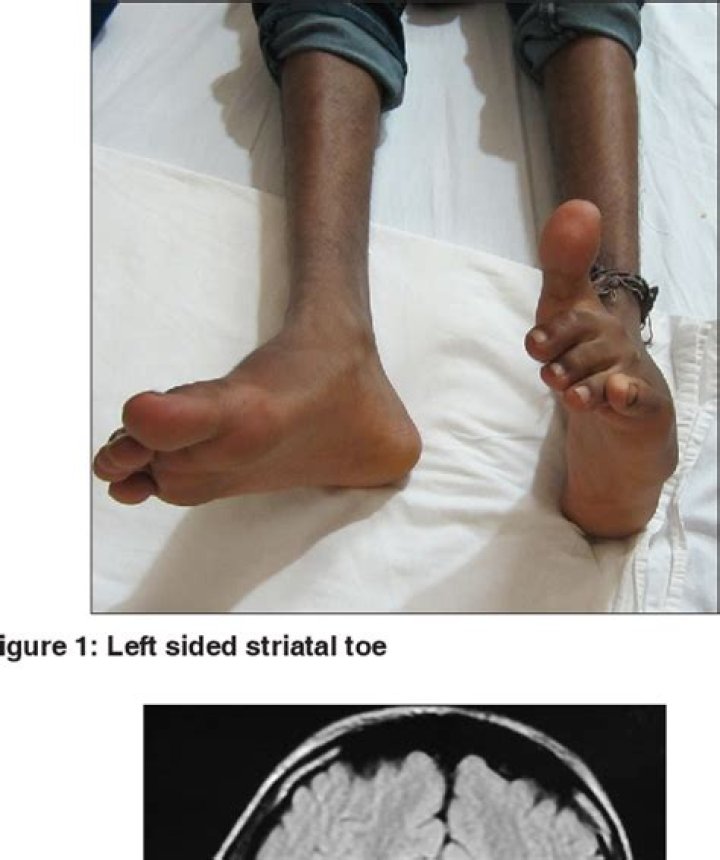 What does striatal toe mean?