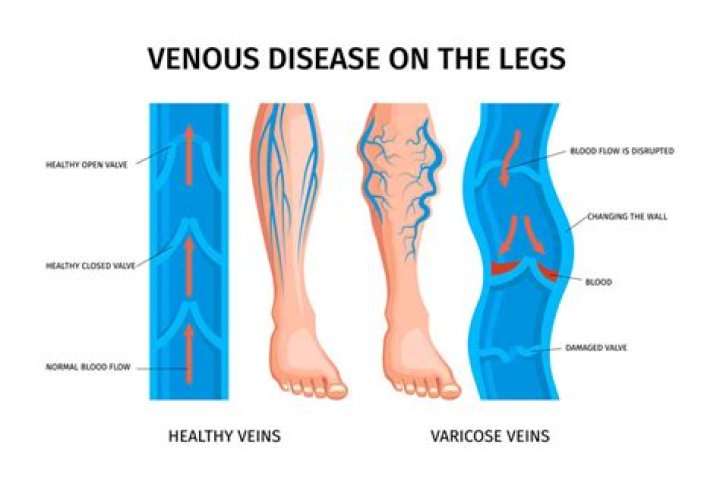 What does venous blood mean?