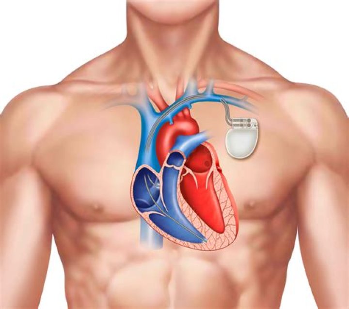 What happens when you get defibrillator?