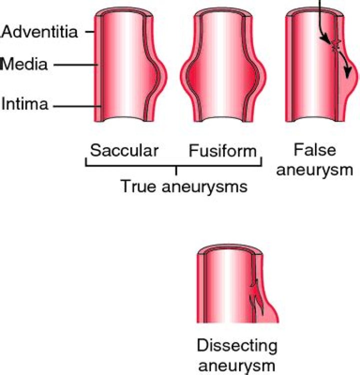 What is a dissecting aneurysm?