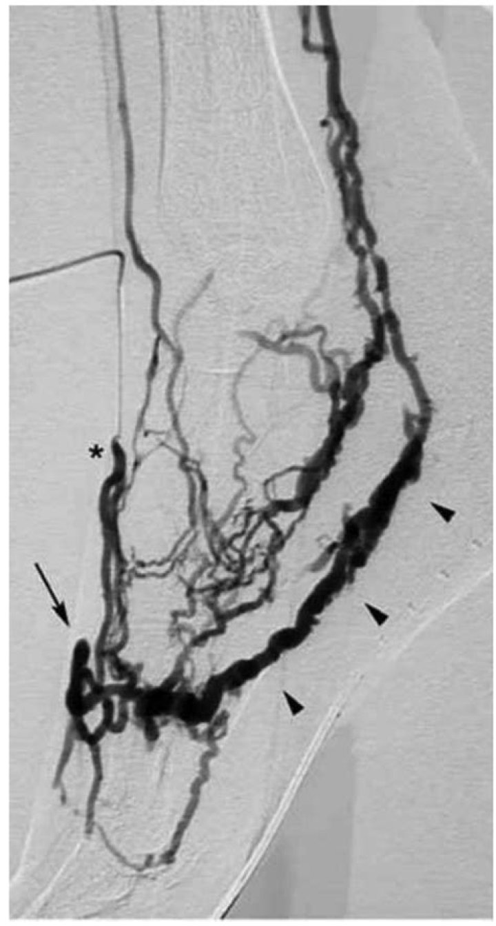 What is a phlebogram used for?