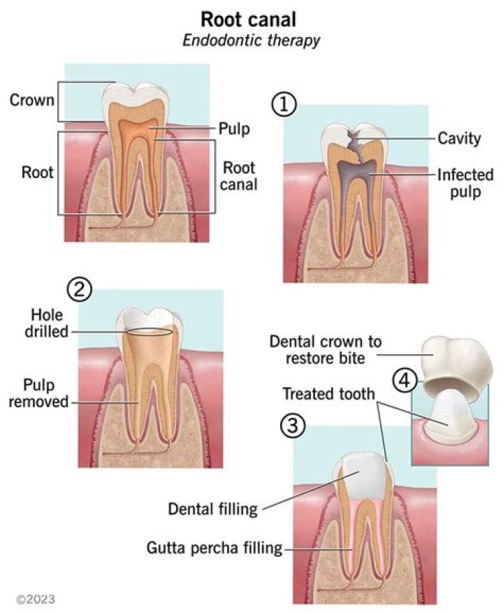 What is AC shaped root canal?