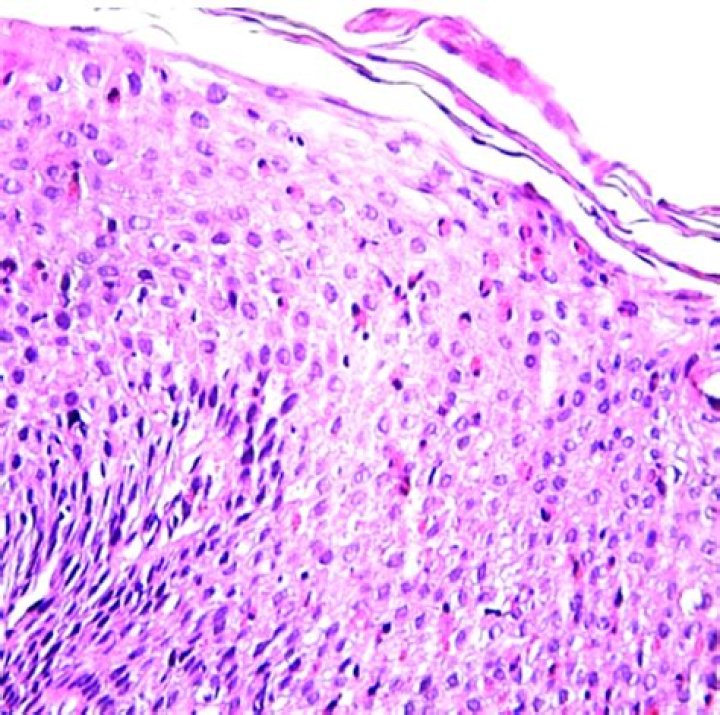 What is intraepithelial eosinophils?