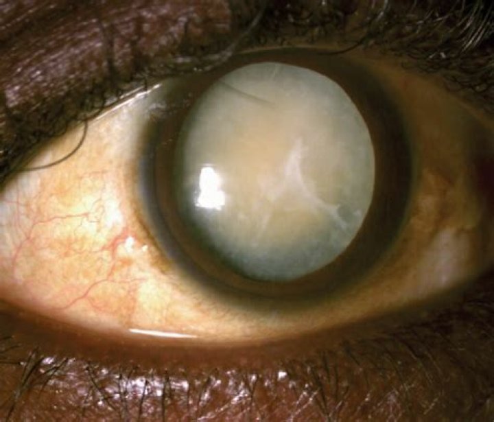 What is intumescent cataract?