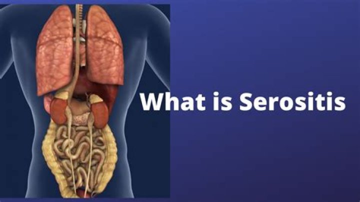 What is multiple serositis?