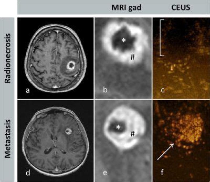 What is radionecrosis brain?