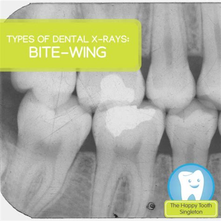 What teeth are bitewings?