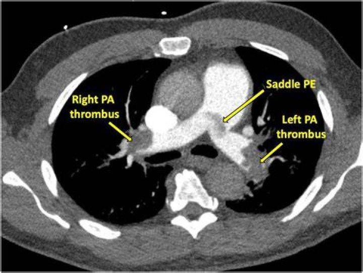 Whats a saddle embolus?