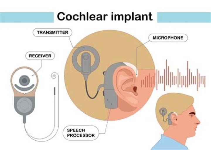 When did cochlear implants become popular?