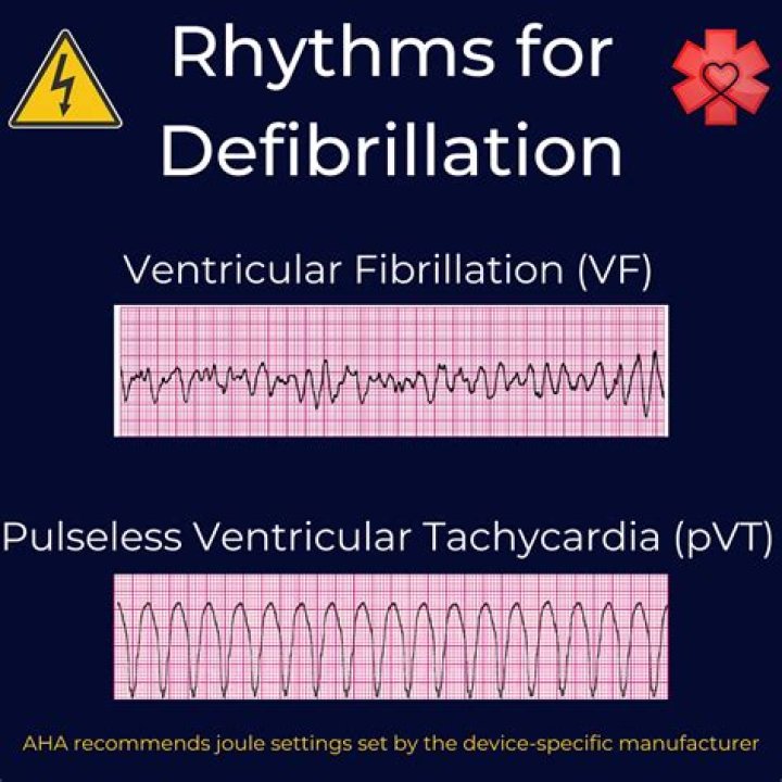 When do we defibrillate?