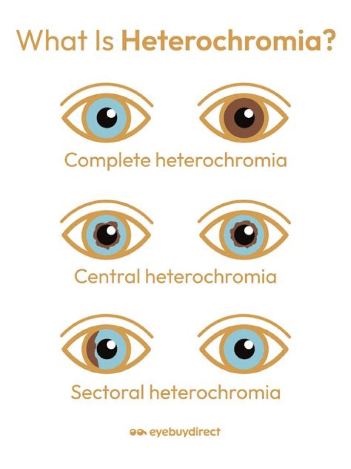 When do you get heterochromia?