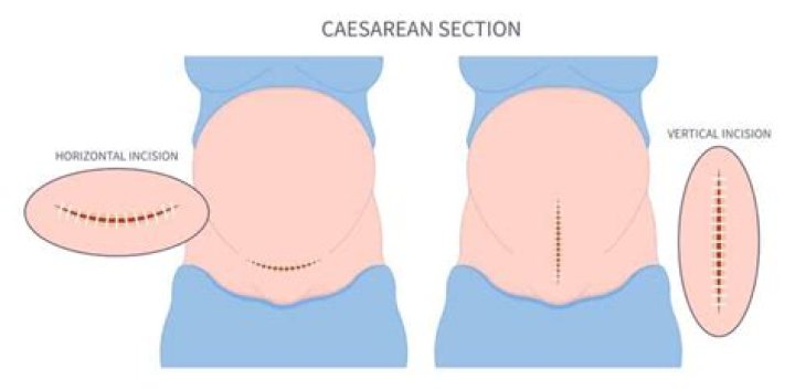 When does c section incision heal?