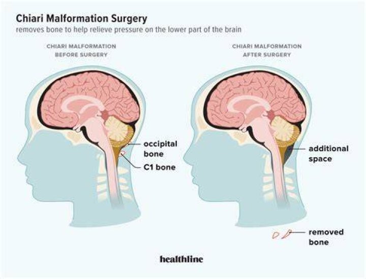 When does chiari malformation require surgery?